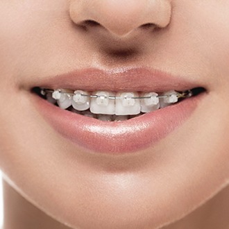 Closeup of smile with clear and ceramic braces