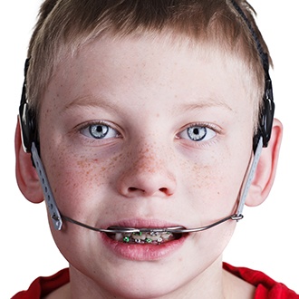 Smiling preteen boy with headgear as part of dentofacial orthopedic treatment