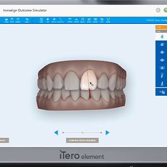 Digital dental impressions on chairside computer
