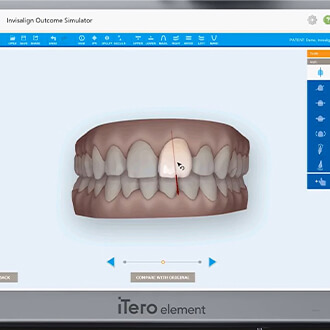 Digital dental impressions on chairside computer