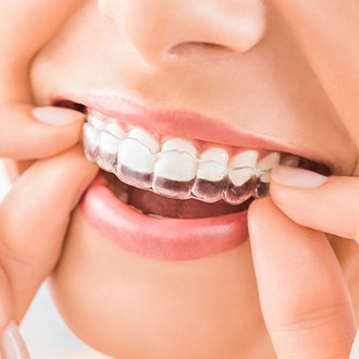 Closeup of patient placing Invisalign tray