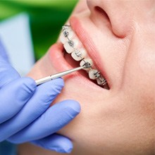 a close-up of braces being adjusted
