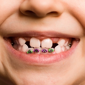 Closeup of smile during pediatric orthodontic treatment