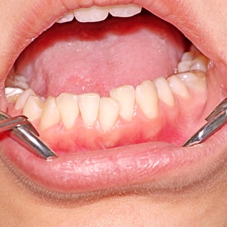 An up-close image of a person’s crowded teeth on the lower arch