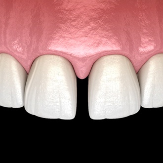 A digital image of a row of teeth with a large gap between the two upper front two teeth