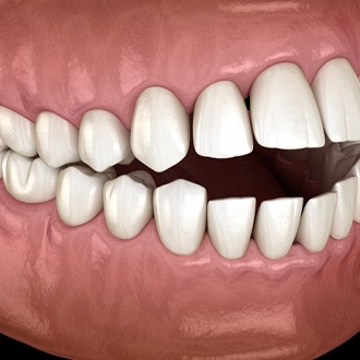 A digital image of an open bite with the back teeth touch and the front teeth apart