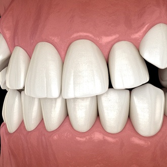 A digital image of impacted canine teeth