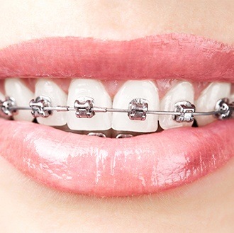 Closeup of smile with self-ligating braces