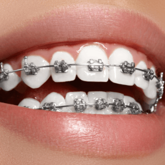 Closeup of smile with self ligating braces