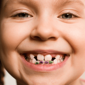 Young child with pediatric orthodontics appliance in place