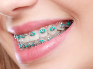 Closeup of patient undergoing orthodontic treatment