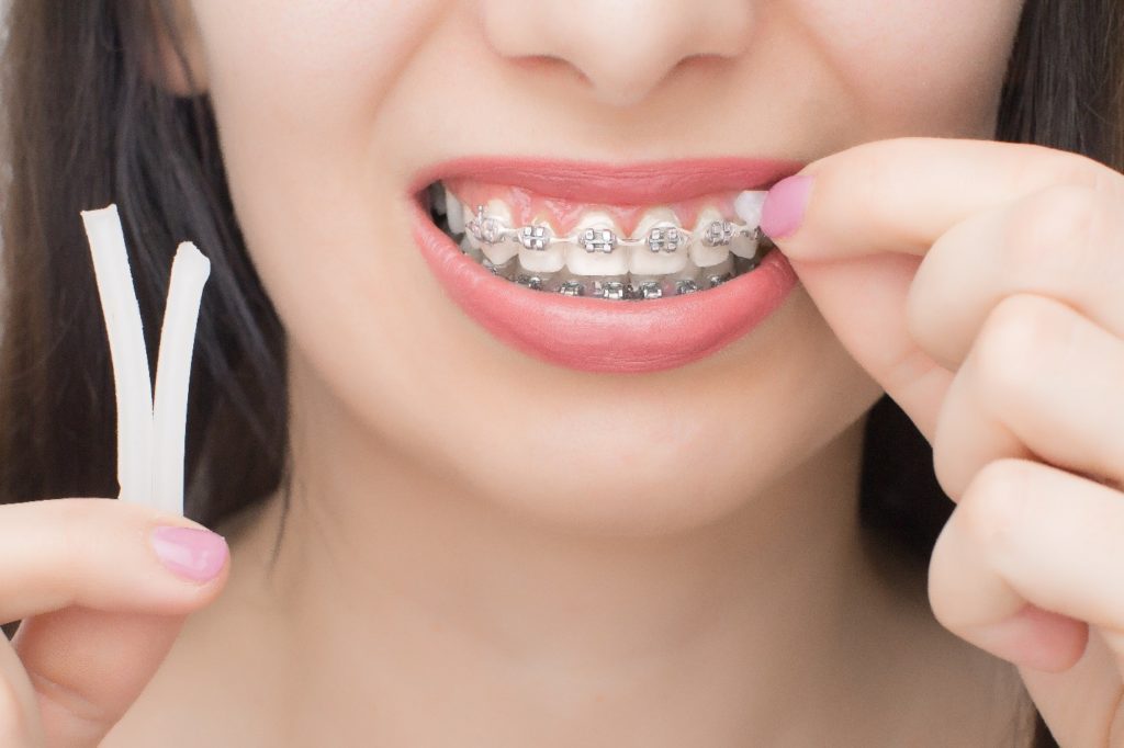 Closeup of woman smiling while applying dental wax