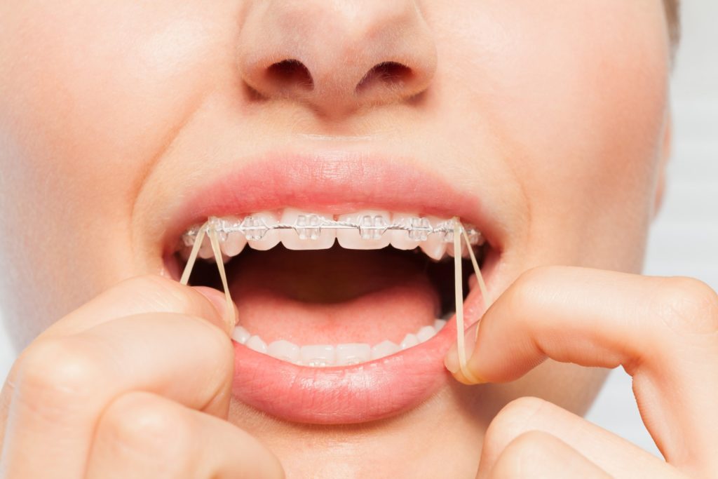 Closeup of woman putting rubber bands on braces
