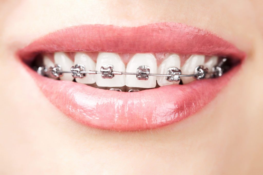 Woman with braces in Framingham smiling
