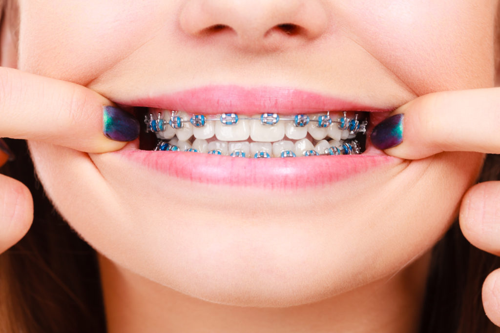 Closeup of patient's braces with blue rubber bands